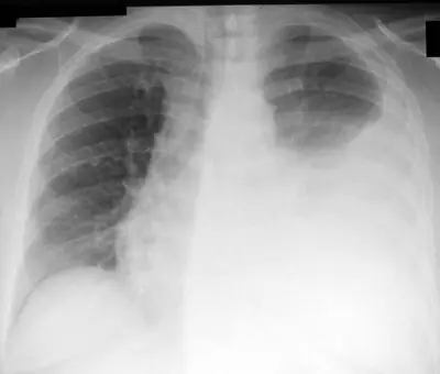 Radiograph from the case bank: Pleural effusion