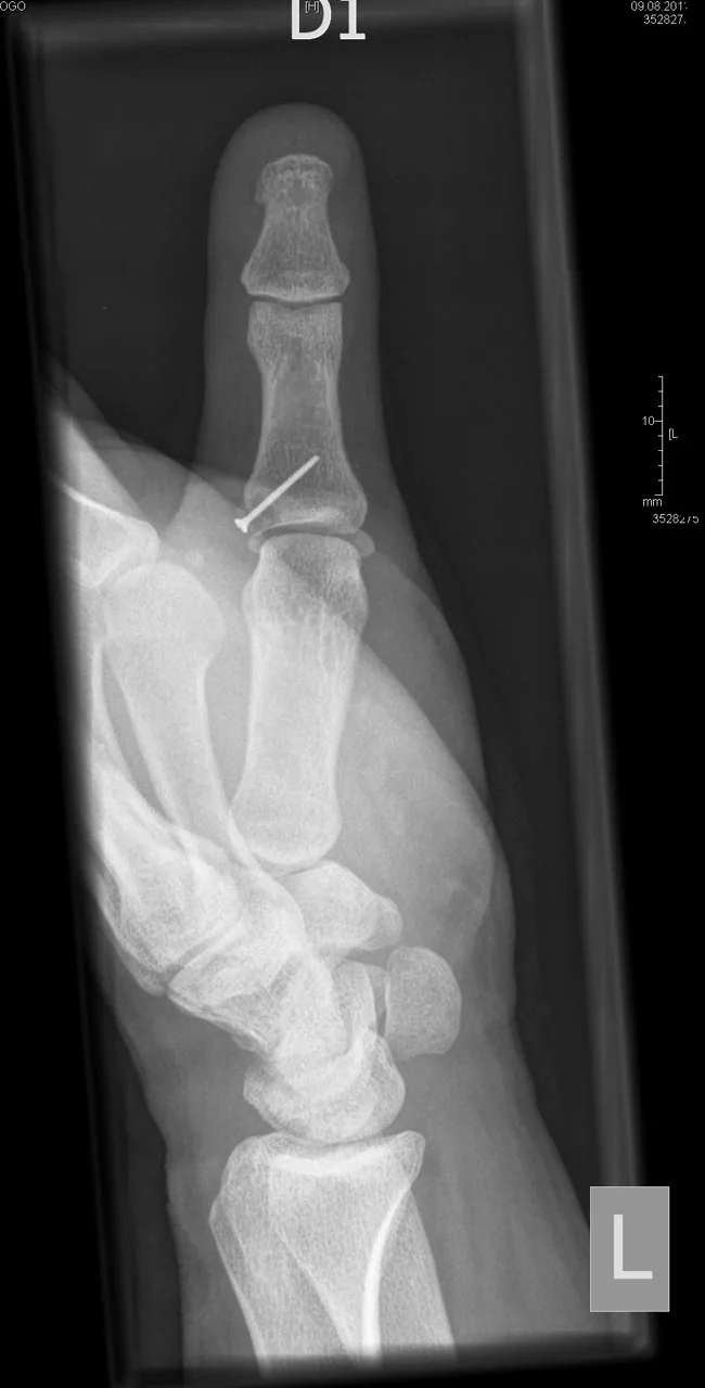 Upper limb radiograph for self-assessment