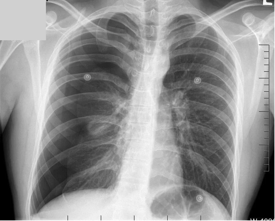 Chest radiograph for self-assessment