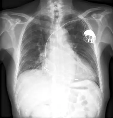 Radiograph from the case bank: Cardiac pacemaker
