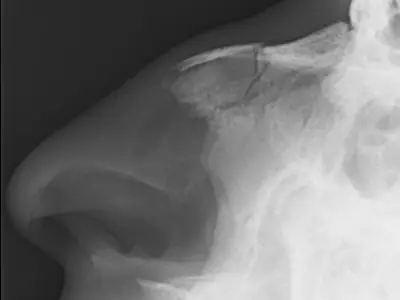 Radiograph from the case bank: Nasal bone fracture