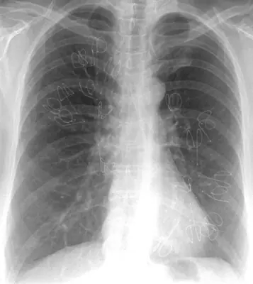 Radiograph from the case bank: Emphysema / COPD (hyperinflation)