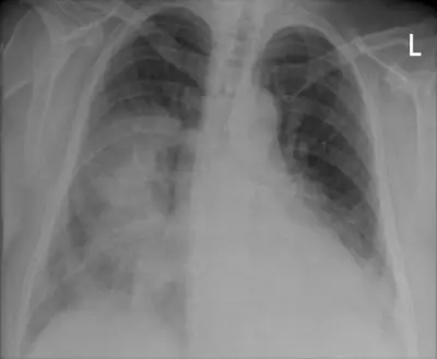 Radiograph from the case bank: Pneumonia (consolidation)