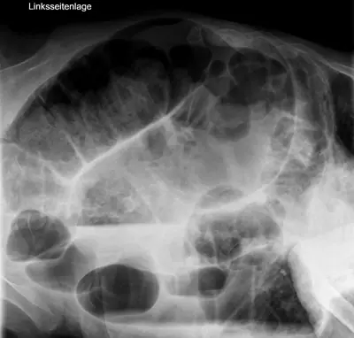 Radiograph from the case bank: Volvulus