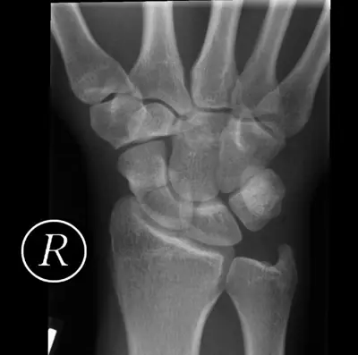Radiograph from the case bank: Scaphoid fracture
