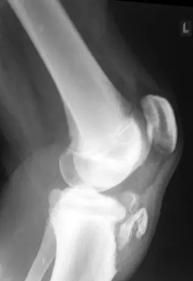 Radiograph from the case bank: Tibial (and fibular) shaft fracture