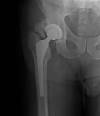 Radiograph from the case bank: Heterotopic ossification