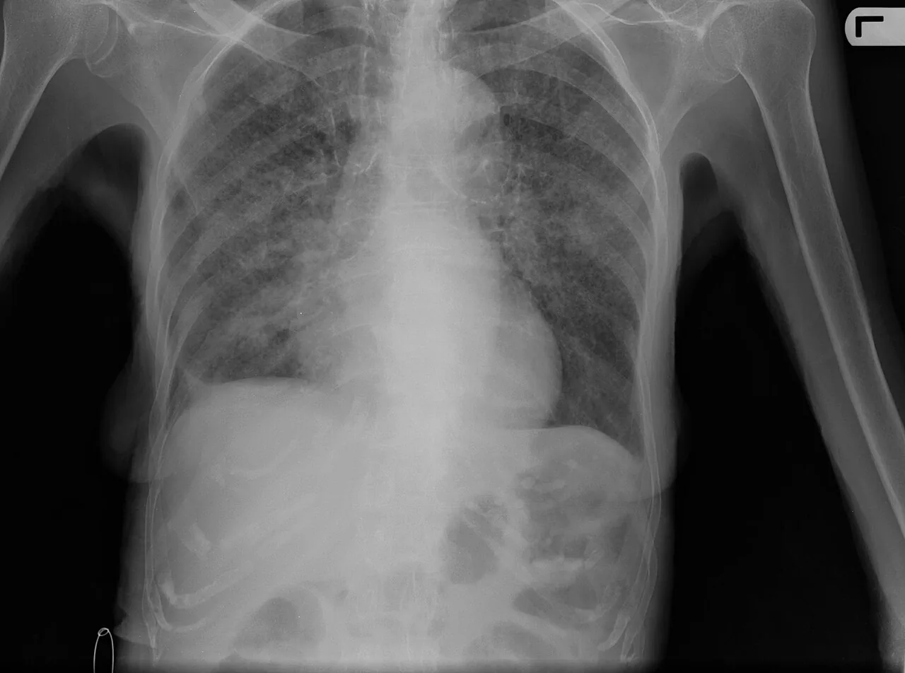 Chest radiograph for self-assessment