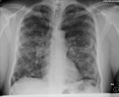 Radiograph from the case bank: Sarcoidosis