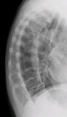 Radiograph from the case bank: Diffuse idiopathic skeletal hyperostosis (DISH)