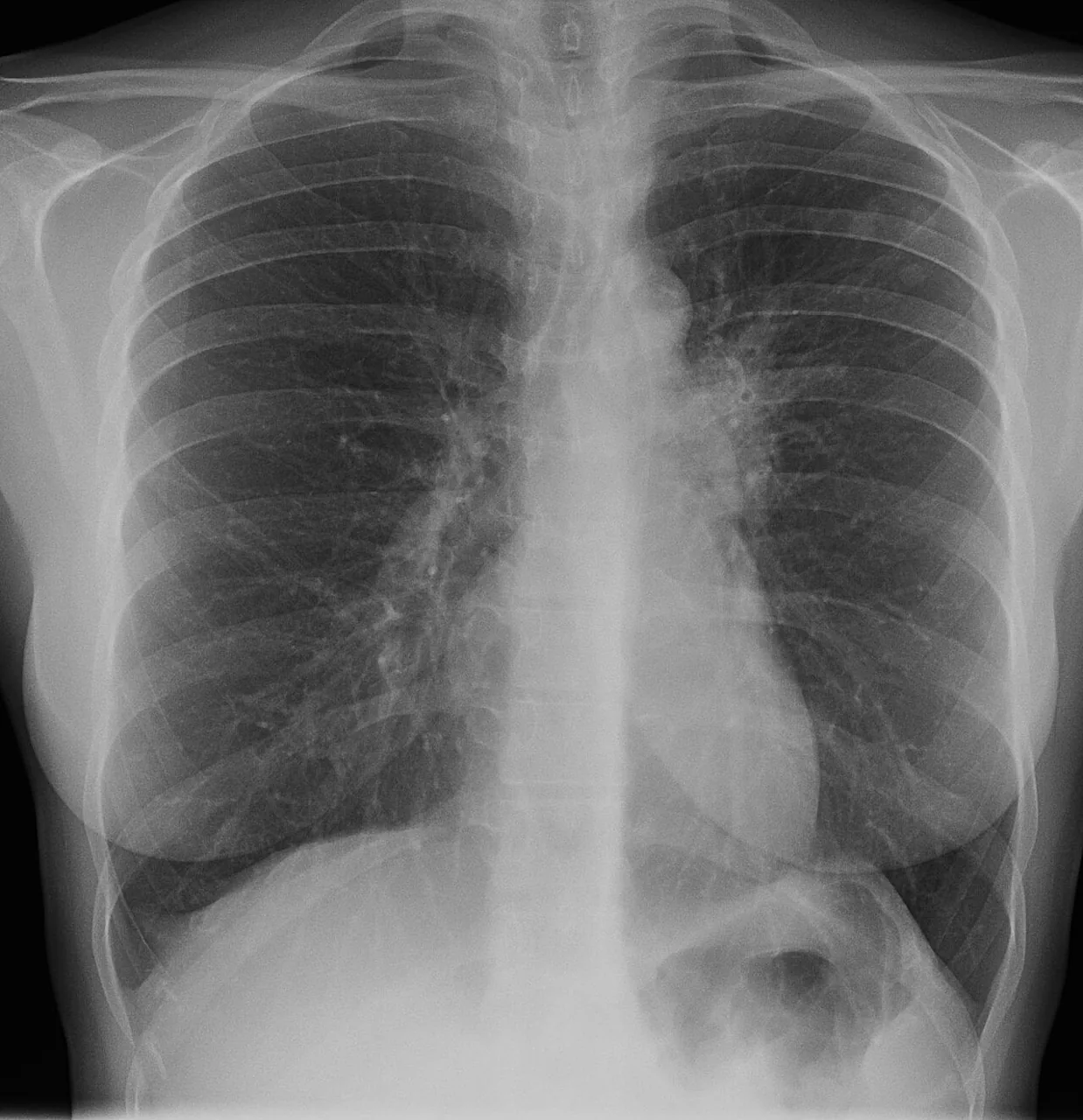 Chest radiograph for self-assessment