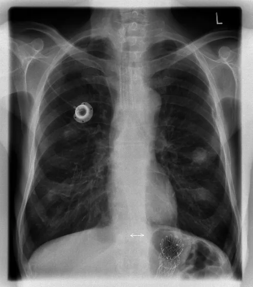 Lines & tubes radiograph for self-assessment