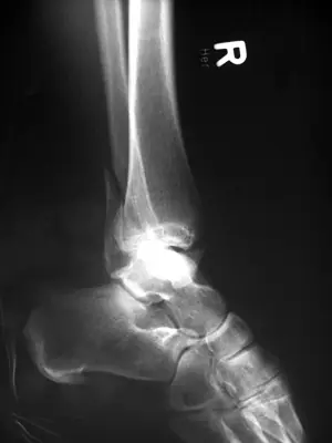 Radiograph from the case bank: Bimalleolar ankle fracture