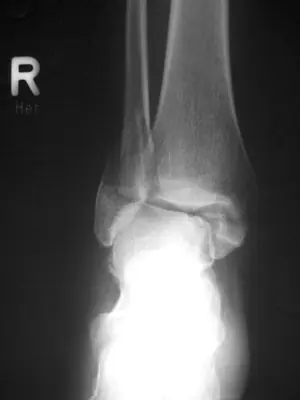 Radiograph from the case bank: Bimalleolar ankle fracture