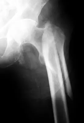Radiograph from the case bank: Hip (proximal femoral) fracture