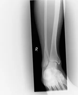 Radiograph from the case bank: Ankle fracture (lateral malleolus)