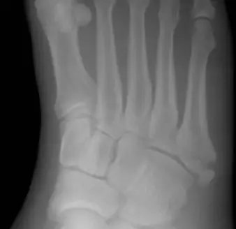 Radiograph from the case bank: Fifth metatarsal fracture (Jones / base)