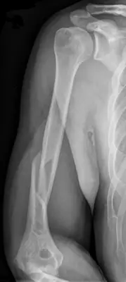 Radiograph from the case bank: Humeral shaft fracture