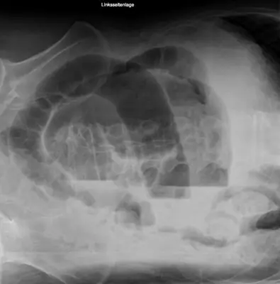 Radiograph from the case bank: Volvulus