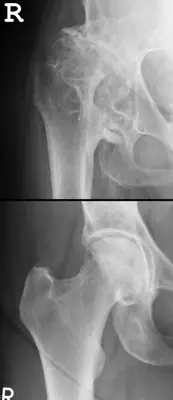 Radiograph from the case bank: Developmental dysplasia of the hip (DDH)