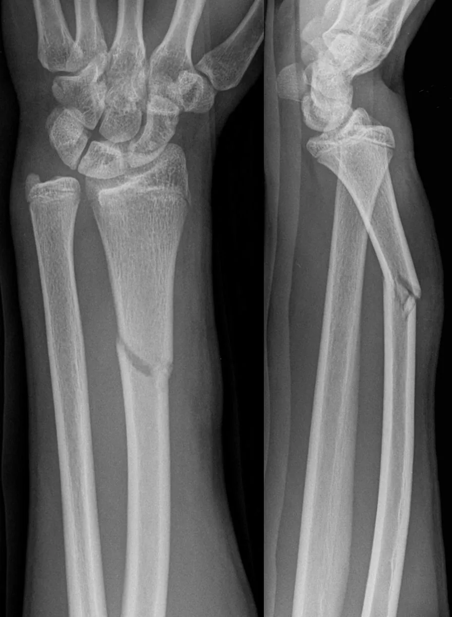Upper limb radiograph for self-assessment