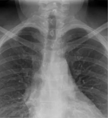 Radiograph from the case bank: Cervical rib