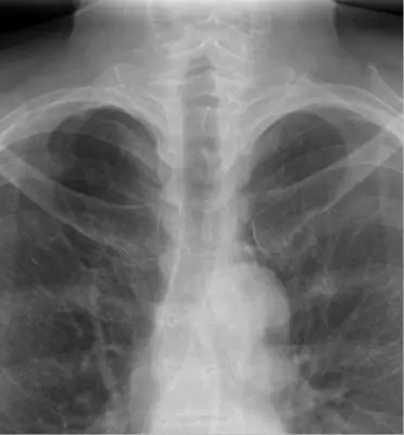 Radiograph from the case bank: Cervical rib