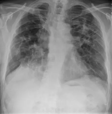Radiograph from the case bank: Sarcoidosis