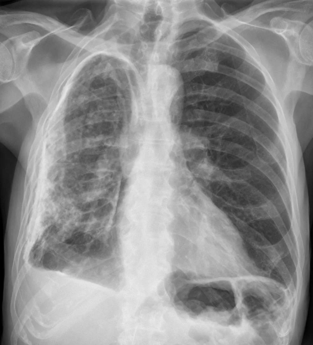 Chest radiograph for self-assessment