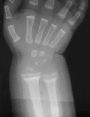 Radiograph from the case bank: Rickets