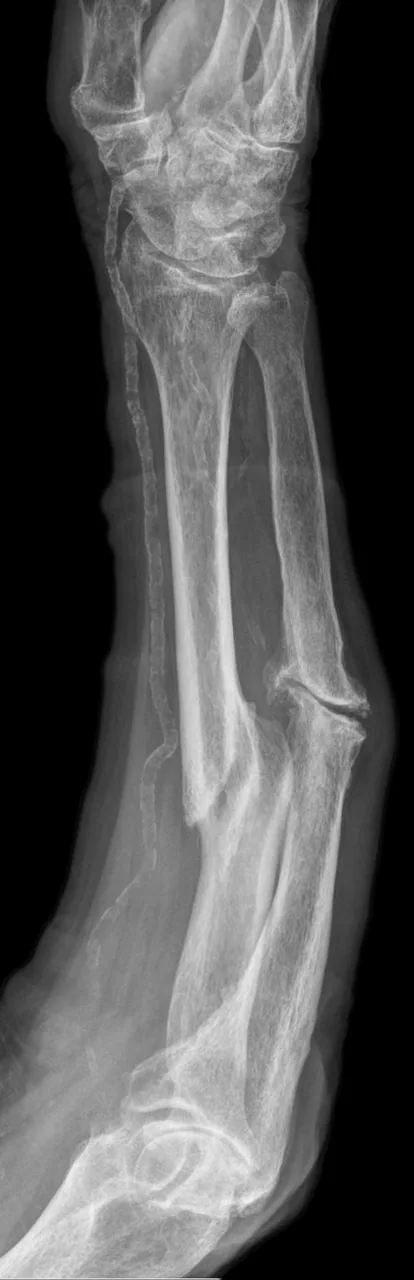 Upper limb radiograph for self-assessment