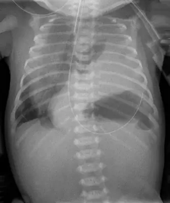 Radiograph from the case bank: Diaphragmatic hernia