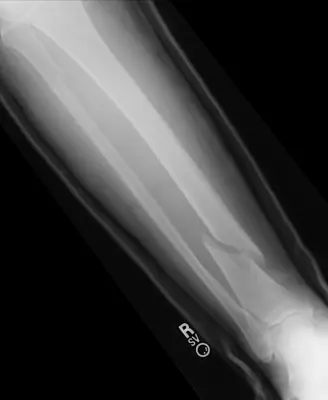 Radiograph from the case bank: Tibial (and fibular) shaft fracture