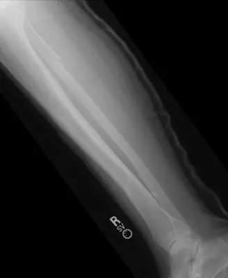Radiograph from the case bank: Tibial (and fibular) shaft fracture