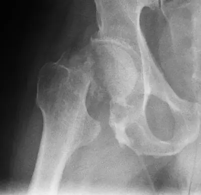 Radiograph from the case bank: Hip (proximal femoral) fracture
