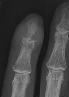Radiograph from the case bank: Gout