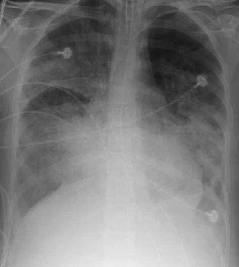 Chest radiograph for self-assessment
