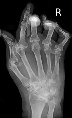 Radiograph from the case bank: Rheumatoid arthritis