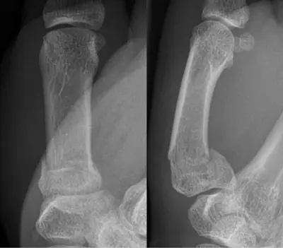 Radiograph from the case bank: Metacarpal fracture