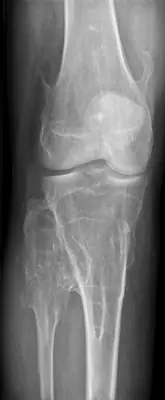Radiograph from the case bank: Osteochondroma (exostosis)