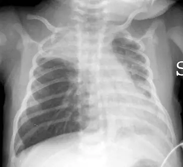 Radiograph from the case bank: Lung collapse (atelectasis)
