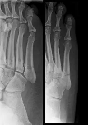 Radiograph from the case bank: Fifth metatarsal fracture (Jones / base)