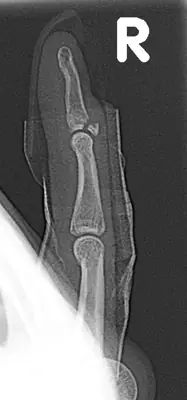 Radiograph from the case bank: Finger (phalangeal) fracture