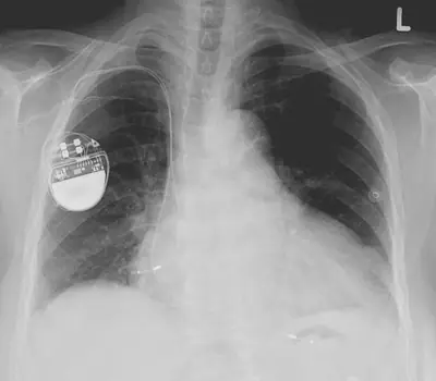 Radiograph from the case bank: Cardiac pacemaker