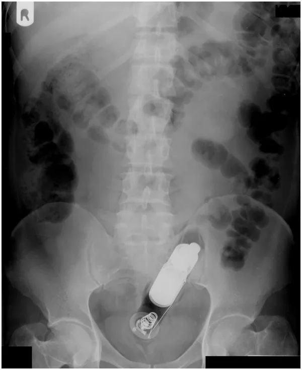 Abdomen radiograph for self-assessment