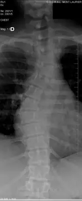Radiograph from the case bank: Scoliosis