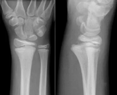 Radiograph from the case bank: Distal radius fracture