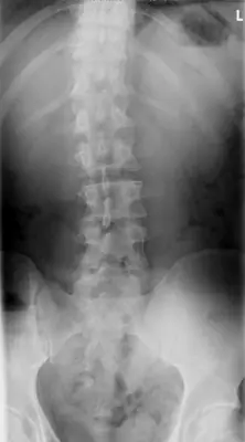 Radiograph from the case bank: Scoliosis