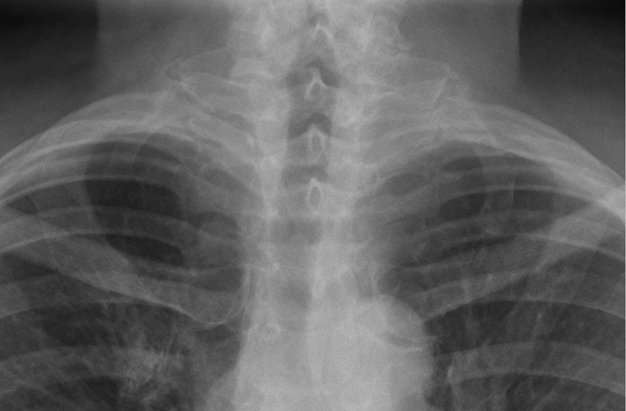 Chest radiograph for self-assessment
