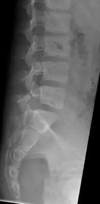 Radiograph from the case bank: Spondylolysis (pars defect)